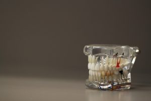Sparen beim Zahnimplantat mit Copycats und Preisvergleich 