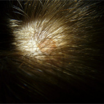 Leberflecken und Muttermale– Kennen Sie Ihr Hautkrebs-Risiko