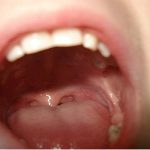 Staerkung der Kaumuskulatur - besonders wichtig nach Kieferbruch