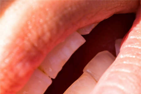 Zahn- und Mundhygiene bei Kieferbruch und operativen Eingriffen