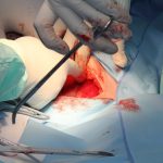 Organspende - Mut zur Entscheidung