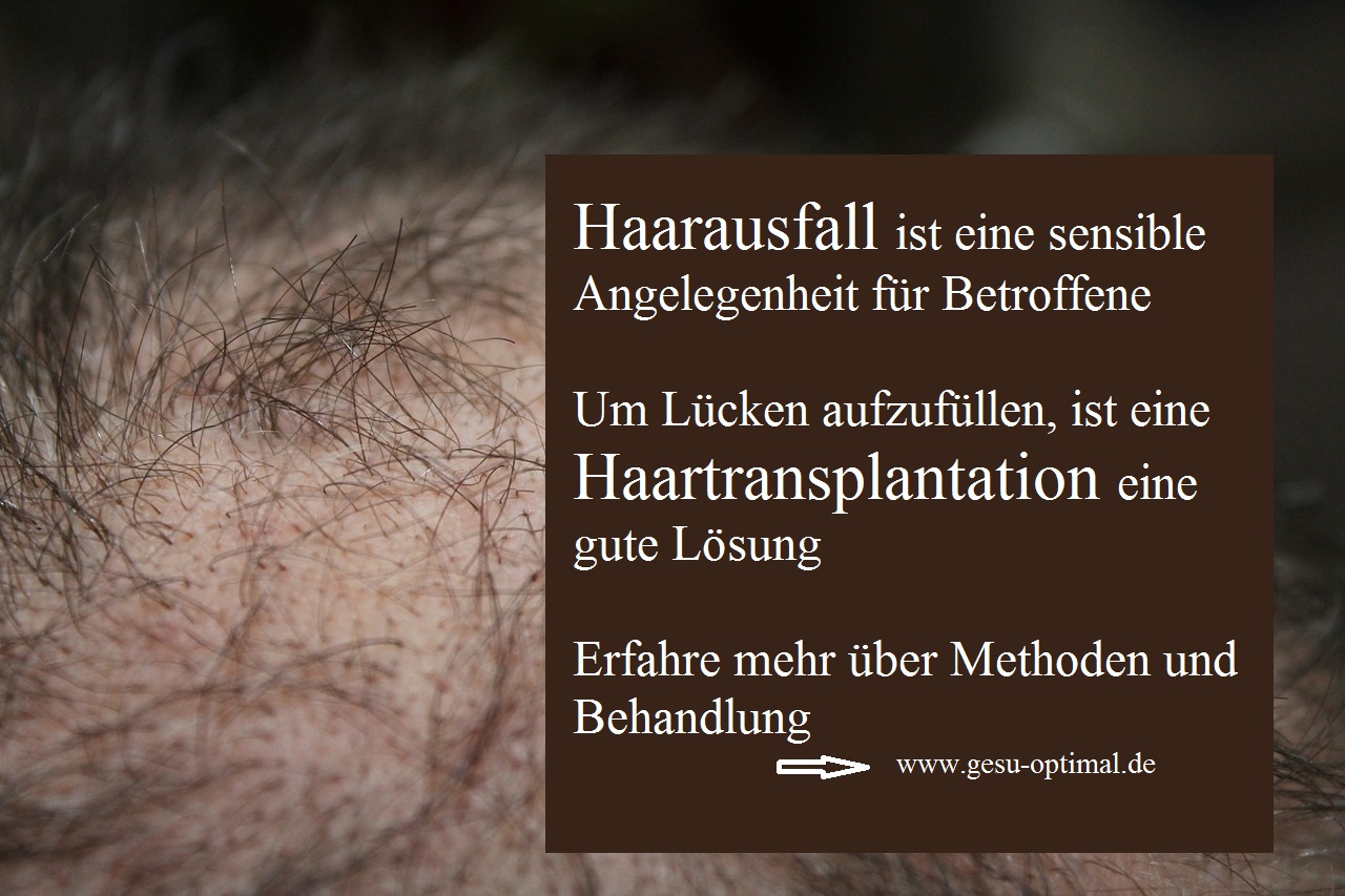 Haarausfall – Haartransplantation füllt die Lücken